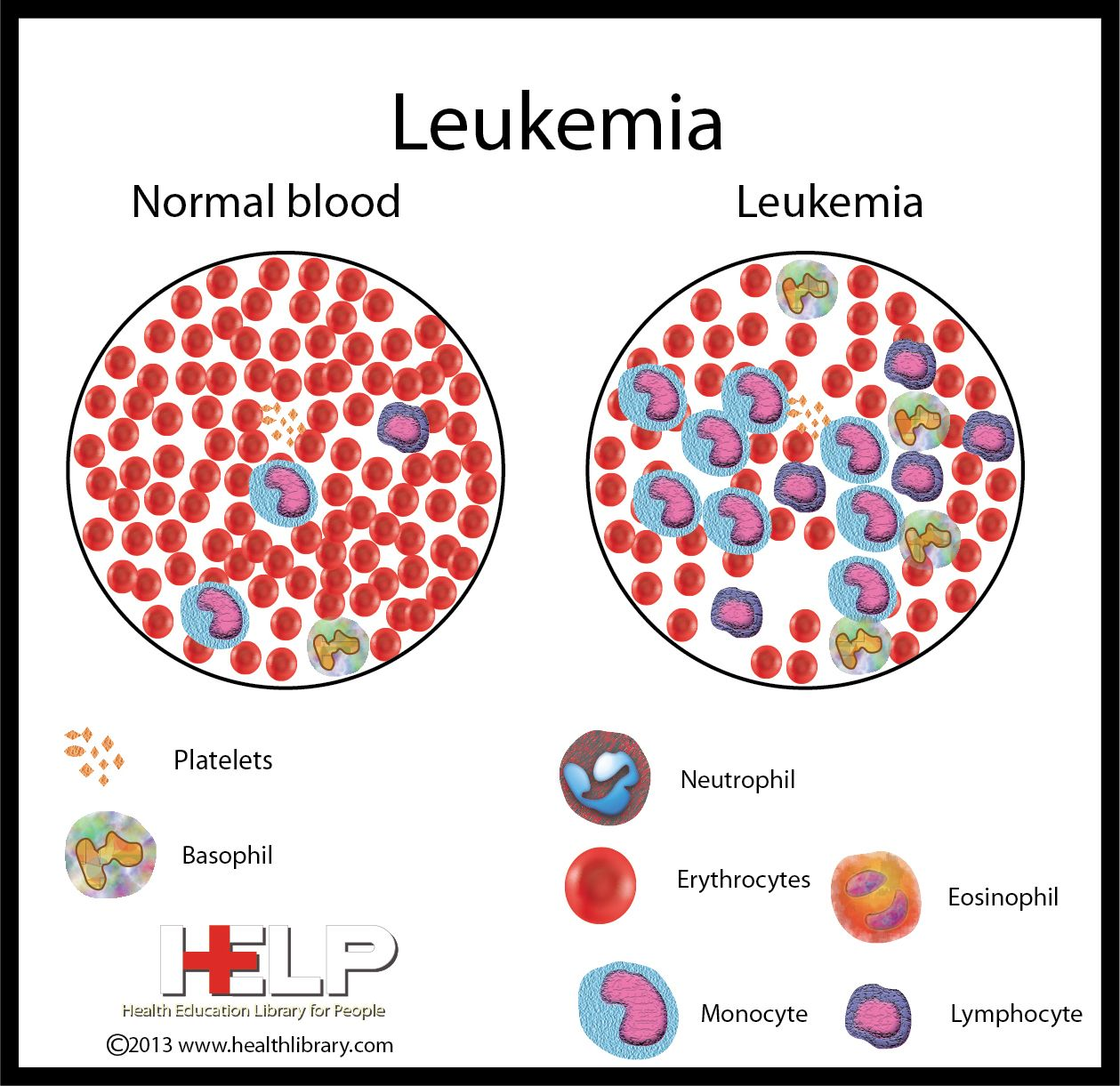 leukemias