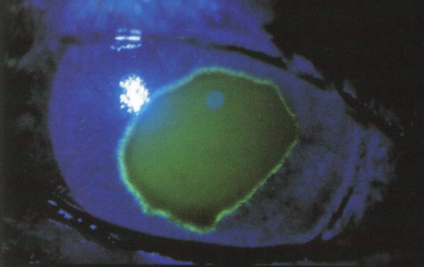 <p>1. conj or corneal foreign body</p><p>2. conj or corneal abrasion</p><p>3. iritis</p><p>4. HZO</p><p>5. post-surgical → PRK, PTK, superficial keratectomy</p><p>image - corneal abrasion</p>