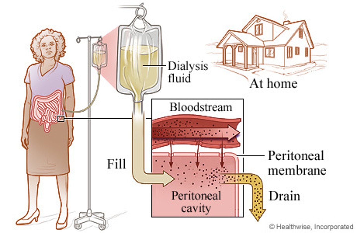 <p><strong>involves instillation of a hypertonic solution into the peritoneal cavity</strong><br>→dialysate solution fills the peritoneal cavity, coming into contact with capillaries in peritoneum and viscera<br>→peritoneum serves as the filtration membrane, diffuses toxins and excess fluid from the blood<br>→toxins and excess fluid cross the membrane into the dialysis solution, are drained out of the body</p>