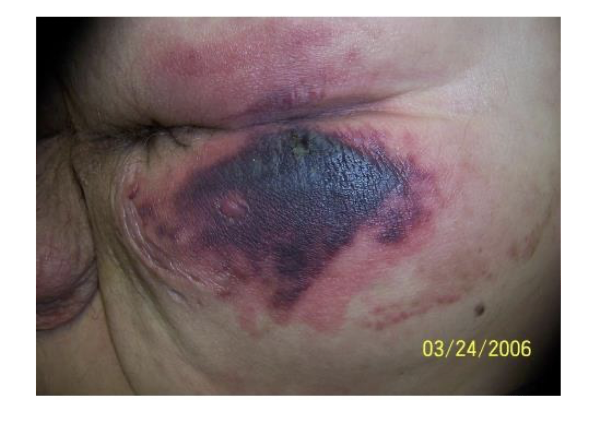 <ul><li><p><strong><u>Persistent, NON-Blanchable; Deep Red, Maroon, or Purple Discoloration, or Blood Blister</u></strong></p></li><li><p><strong>Pain and Temp </strong>often precedes skin color changes </p></li><li><p>Results from:</p><ul><li><p>Intense and/or prolonged tissue pressure and shear foces at the bone-muscle interface</p></li></ul></li></ul><p></p>