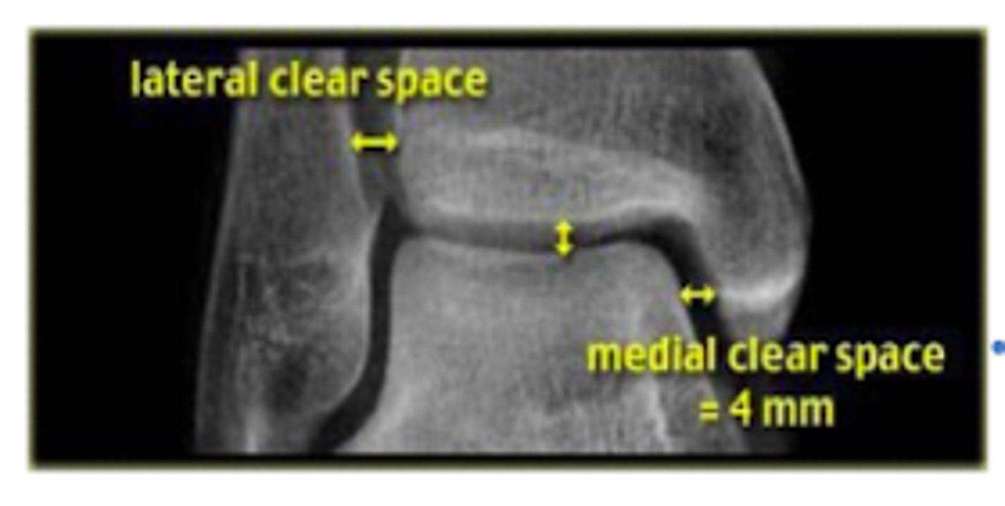 <p>indicates disruption of the medial collateral ligament</p><p>- should be <4mm</p>