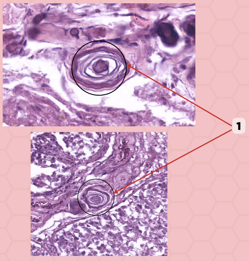 <p>True or False: These (#1) are extracellular/calcified bodies that increase with age.</p>