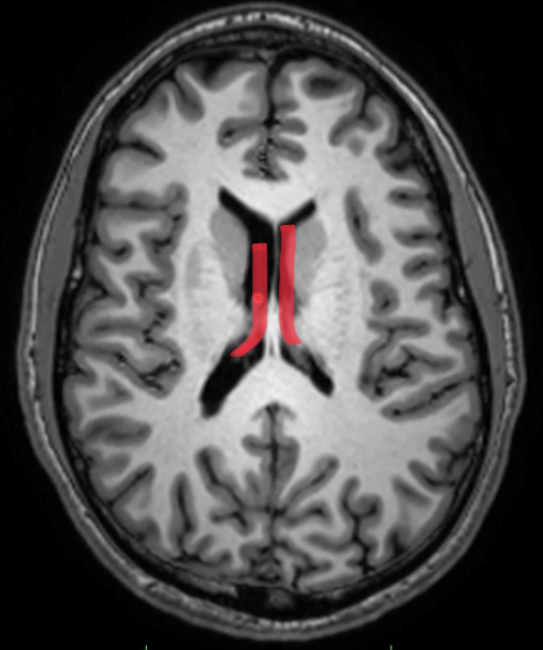 <p>from interventricular foramen to splenium of corpus callosum</p><p>contains choroid plexus (gray stuff in the cavity)</p><p>posterior wall: splenium</p>