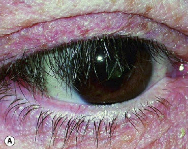 <p>The downward sagging of the upper lid lashes </p>