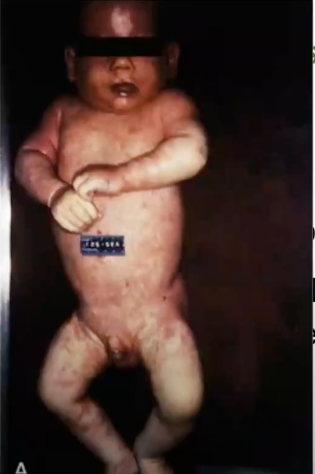 <ol><li><p>Bacterial Meningitis </p></li><li><p>Meningococcemia </p></li><li><p>Waterhouse–Friderichsen syndrome</p></li></ol><p></p>
