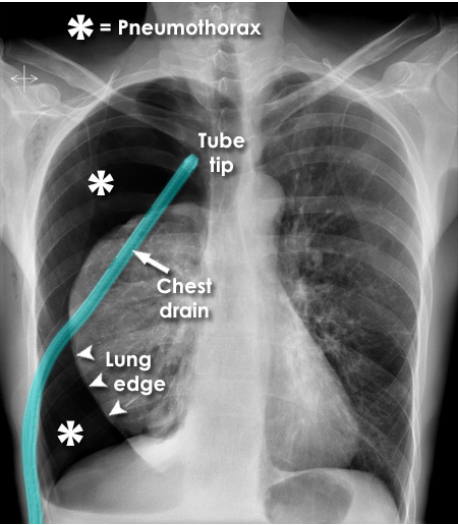 <p>5th intercostal space, slightly anterior to the mid-axillary line.</p>