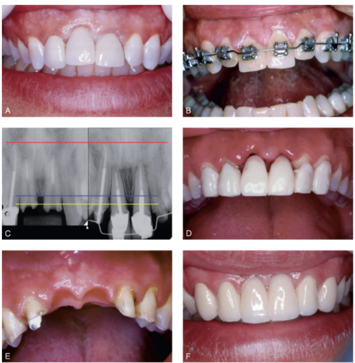 <ul><li><p>additional time and expense </p></li><li><p>endodontic tx necessary beforehand </p></li></ul><p></p>