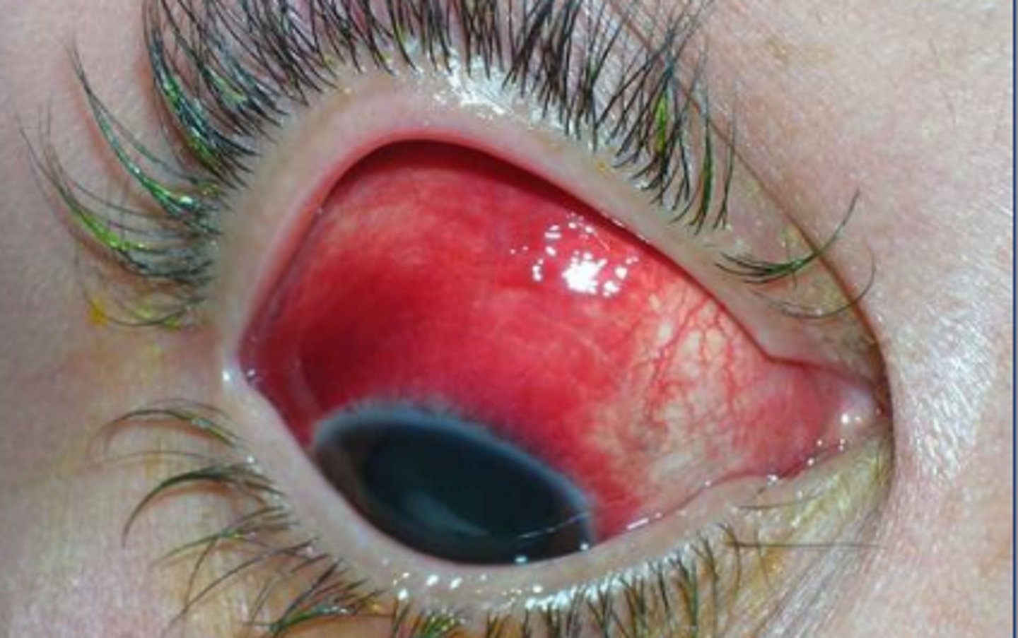 <p>coxsackie A serotype causing acute hemorrhagic conjunctivitis.</p>