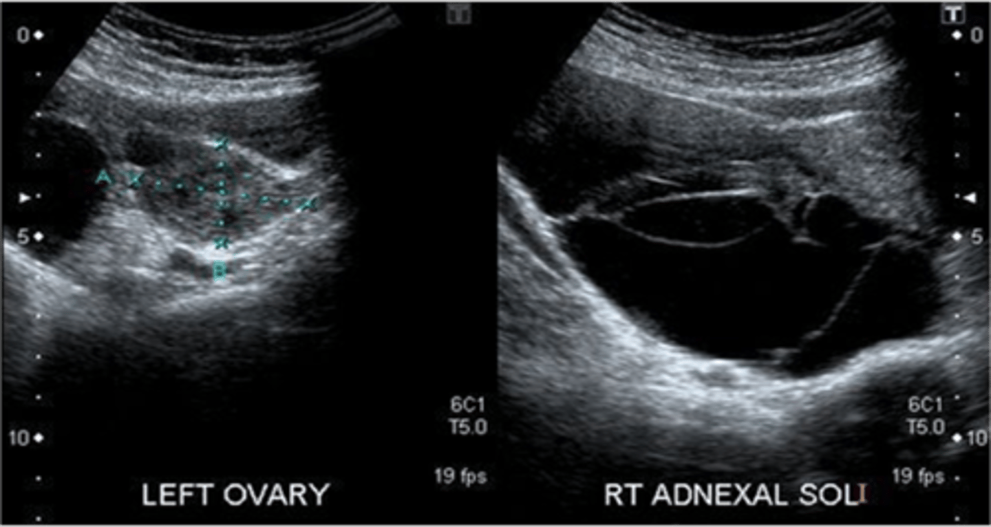 <p>serous cystadenoma</p>