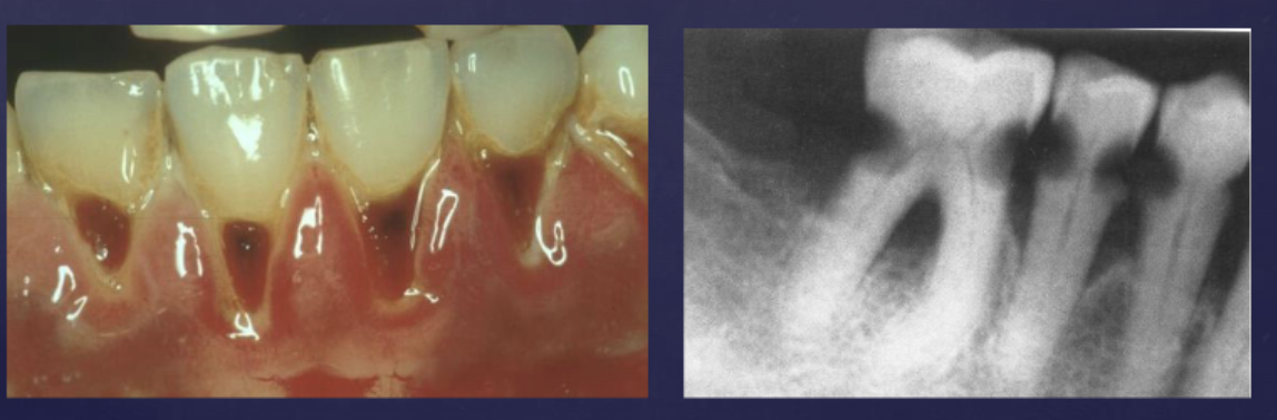 <ul><li><p>radiation caries</p></li><li><p>reduced secretion (xerostomia)</p></li><li><p>pH altered (decalcification of enamel)</p></li></ul><p></p>