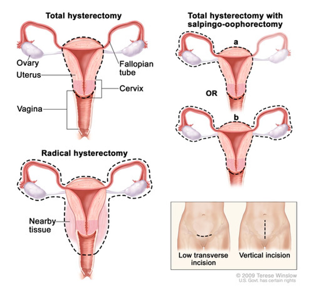 <p>surgical removal of the uterus</p>