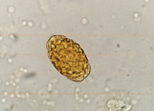 <p>infects the right kidney.</p>