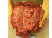 <p>Margin of the lesion</p>
