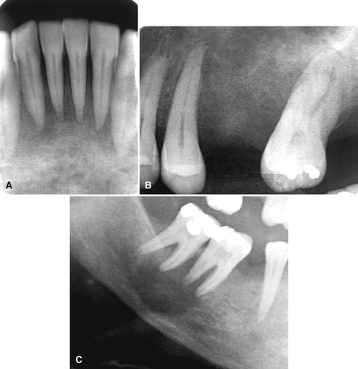 <p>The top images show show loss of lamina dura around the teeth in a patient with _____________. The bottom image shows ________ developing under the molar?</p>