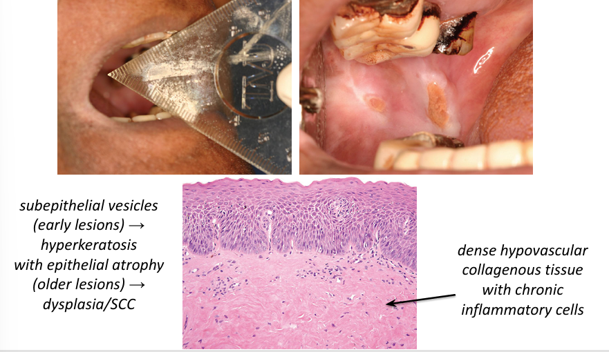 <p>-mucosa develops blotchy, marble-like pallor and progressive stiffness of submucosal tissue</p><p>-most commonly affects buccal mucosa, retromolar area, soft palate</p><p>-palpable submucosal fibrous bands on the buccal mucosa, soft palate, labial mucosa</p><p>-extends to involve oropharynx, upper esophagus</p><p>-if tongue involved: becomes immobile, diminish in size, devoid of papillae</p><p>-white patch often noted- reflect epithelial change (most are hyperkeratosis, 10-15% epithelial dysplasia, 6% SCC)</p>
