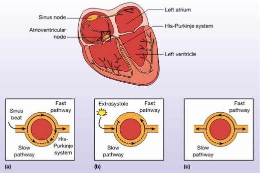<p>What does this refer</p><ul><li><p>Sinus beat is conducted along fast pathway to bundle of His</p></li><li><p>Slow pathway has refractory section, impulse is blocked</p></li><li><p>Ectopic impulse stimulates slow pathway, travels anterograde along His–Purkinje path AND retrograde along fast pathway</p></li><li><p>Also known as “circus rhythm”</p></li></ul><p></p>
