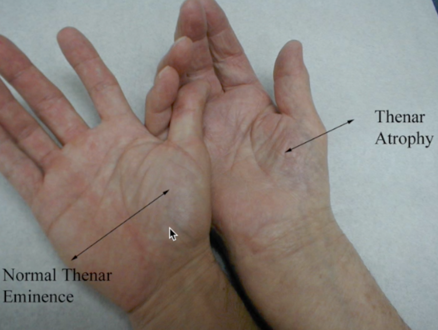 <p>Thenar Atrophy may signify what nerve injury? </p>