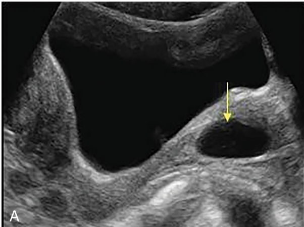 <p>These are the most common cystic lesions of the vagina and usually are found incidentally</p><p>during sonographic examination</p>