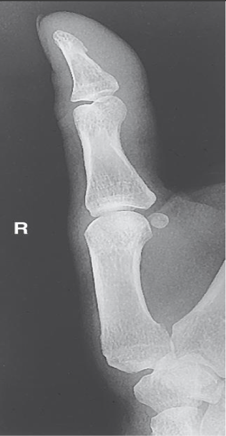 <p><span style="line-height: normal;">• </span>Entire thumb demonstrated including trapezium and CMC joint</p><p class="p1"><span style="line-height: normal;">• </span>Joints partially open as in 45° oblique</p><p class="p1"><span style="line-height: normal;">• </span>Increased concavity of phalanges on side facing fingers</p><p class="p1"><span style="line-height: normal;">• </span>Center of field at first MCP joint</p>