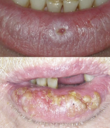 <p>What is the cause of lip squamous cell carcinoma?</p>