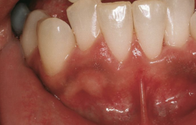 <p><span>Rökare, specifikt kvinnor, på P-piller. Pigmentering buccalt i gingiva ök/uk front</span></p>