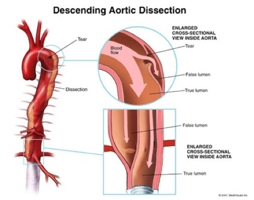 <p>Aortic dissection </p>