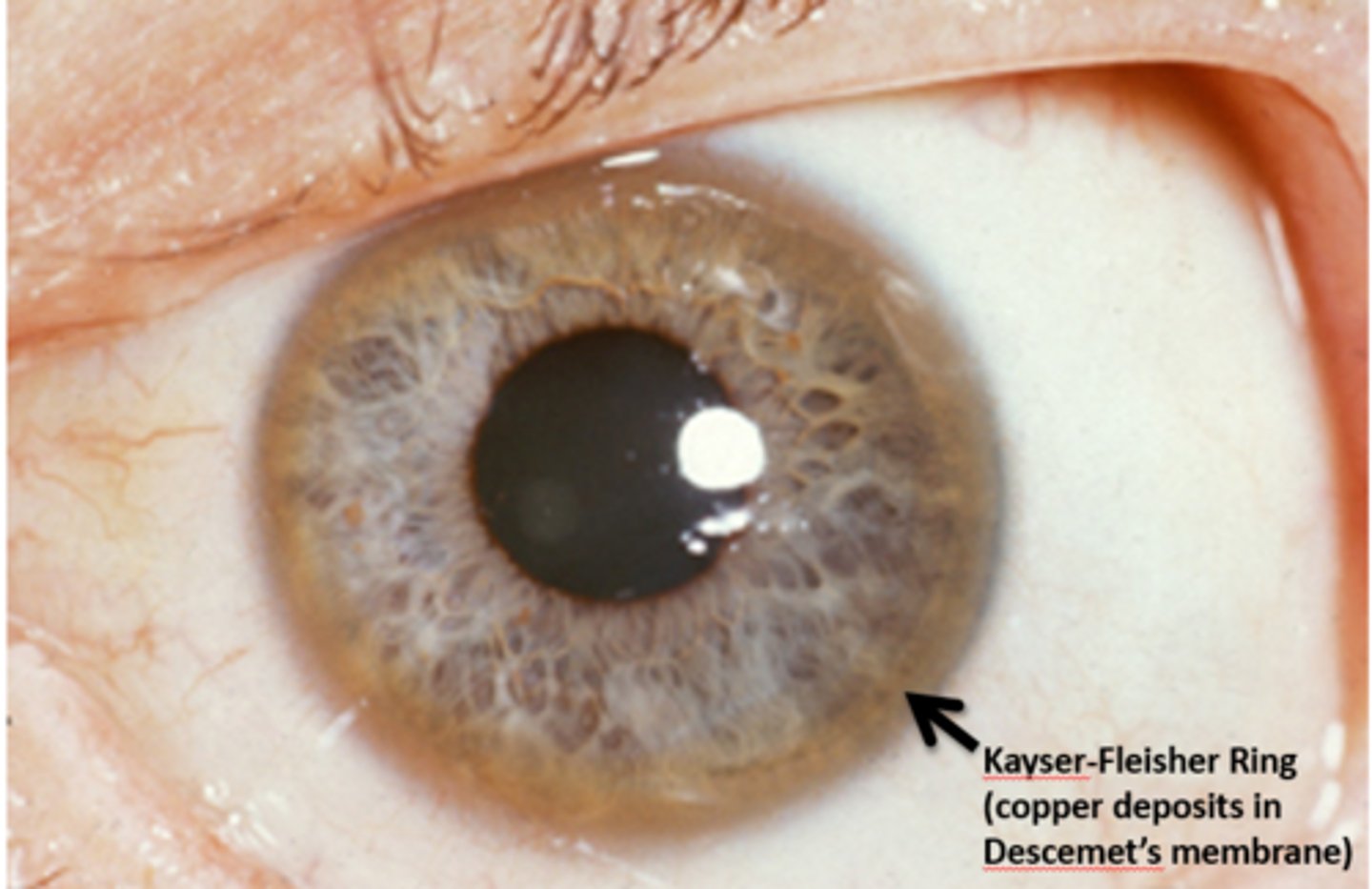 <p>Kayser-Fleisher ring (copper deposits in Descemet's Membrane)</p>