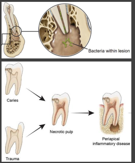 <p>What are the histopathological manifestation charactered by inflammatory infiltrate?</p>