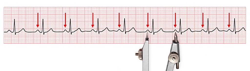 <ul><li><p><strong>Atrial Rhythm:</strong></p><ul><li><p>Look at <strong>P–P intervals</strong> (distance between P waves).</p></li><li><p>If evenly spaced → <strong>regular atrial rhythm</strong>.</p></li><li><p>If uneven → <strong>irregular atrial rhythm</strong>.</p></li></ul></li><li><p><strong>Ventricular Rhythm:</strong></p><ul><li><p>Look at <strong>R–R intervals</strong> (distance between R waves).</p></li><li><p>If evenly spaced → <strong>regular ventricular rhythm</strong>.</p></li><li><p>If uneven → <strong>irregular ventricular rhythm</strong>.</p></li></ul></li><li><p><strong>Tip for both:</strong> Use a piece of paper or calipers to mark and compare spacing.</p></li></ul><p></p>
