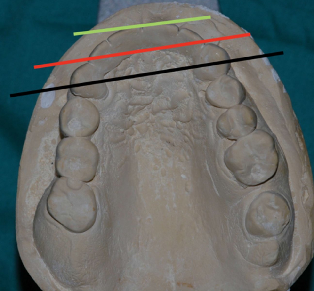 <p>Is having a short or longer cantilever arm from canine line better?</p>
