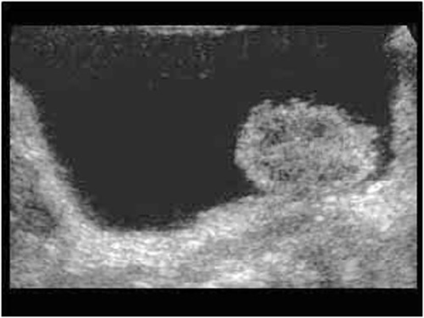 <p>TCC is more frequently found in the ___ </p>