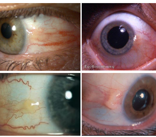 <p>Zone of thickened conjunctival stroma replaced by <strong><u>degenerated collagen and abnormal elastic tissue</u></strong></p>
