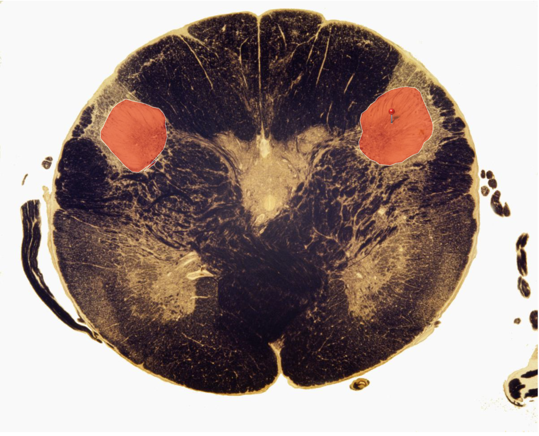 <p>Spinal Trigeminal Nucleus </p><p></p><p>Pain and Temperature from the Skin of the head</p>