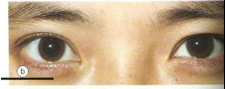 <p>fold in the upper eyelid is known as _________ and is most common in which ethnicities</p>