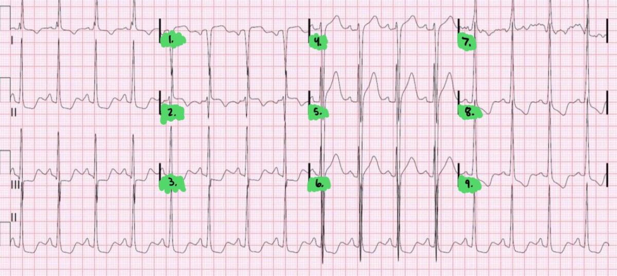 <p>Label the EKG (Ischemia ST depression): (9)</p>