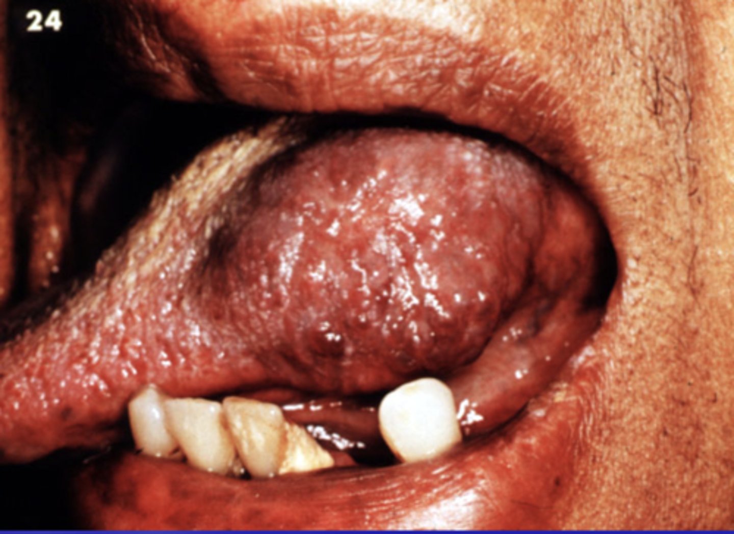 <p>benign tumor/hyperplasia of blood vessels (congenital) </p>