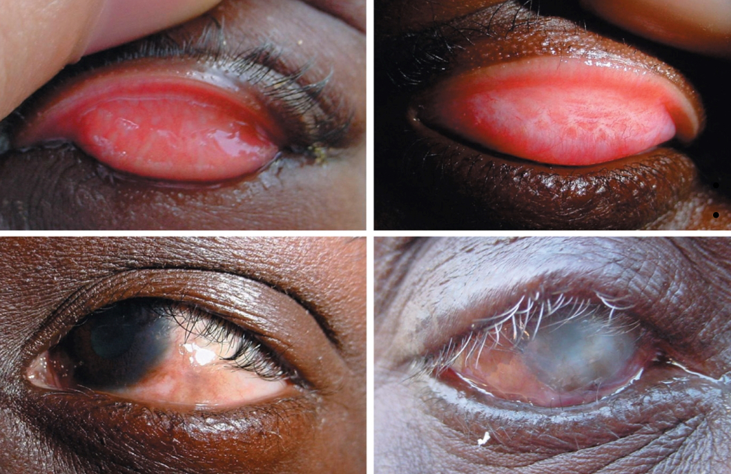 <p><span><span>Agent: </span><em><span>Chlamydia trachomatis</span></em></span></p><p><span><span>Sign and symptoms: </span></span><span style="background-color: transparent;"><span>Scarring of the conjunctiva and cornea;</span></span></p><p><span style="background-color: transparent;"><span> Eyelashes turn inwards, cornea is scratched and irritated by the eyelashes</span></span><br></p>