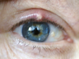 <p>An acute localized staphylococcal infection of sebaceous gland in eyelid. It is painful, red, and swollen—a superficial, elevated lump or pustule at the lid margin. Rubbing the eyes can cause cross-contamination and development of another stye. Managed with warm compresses, topical antibiotic ointment, may be combined with steroid ointment</p>