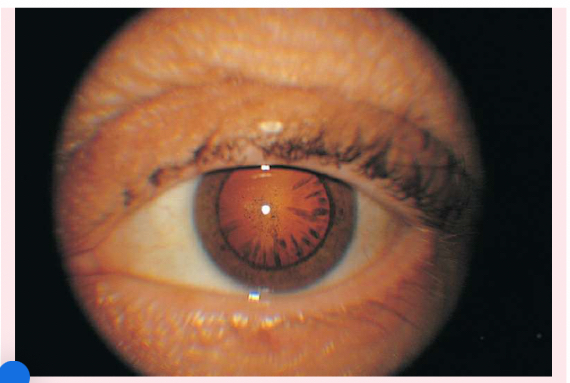<p><span>Peripheral cataracts</span></p>