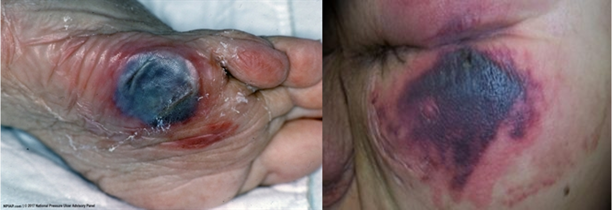 <p><strong>What stage pressure injury?</strong></p><ul><li><p>persistent localized area of nonblanchable deep red or purple skin </p></li><li><p>intact or non-intact</p></li><li><p>can also present as blood filled blisters</p></li><li><p>caused by damage to underlying soft tissues</p></li></ul><p></p>