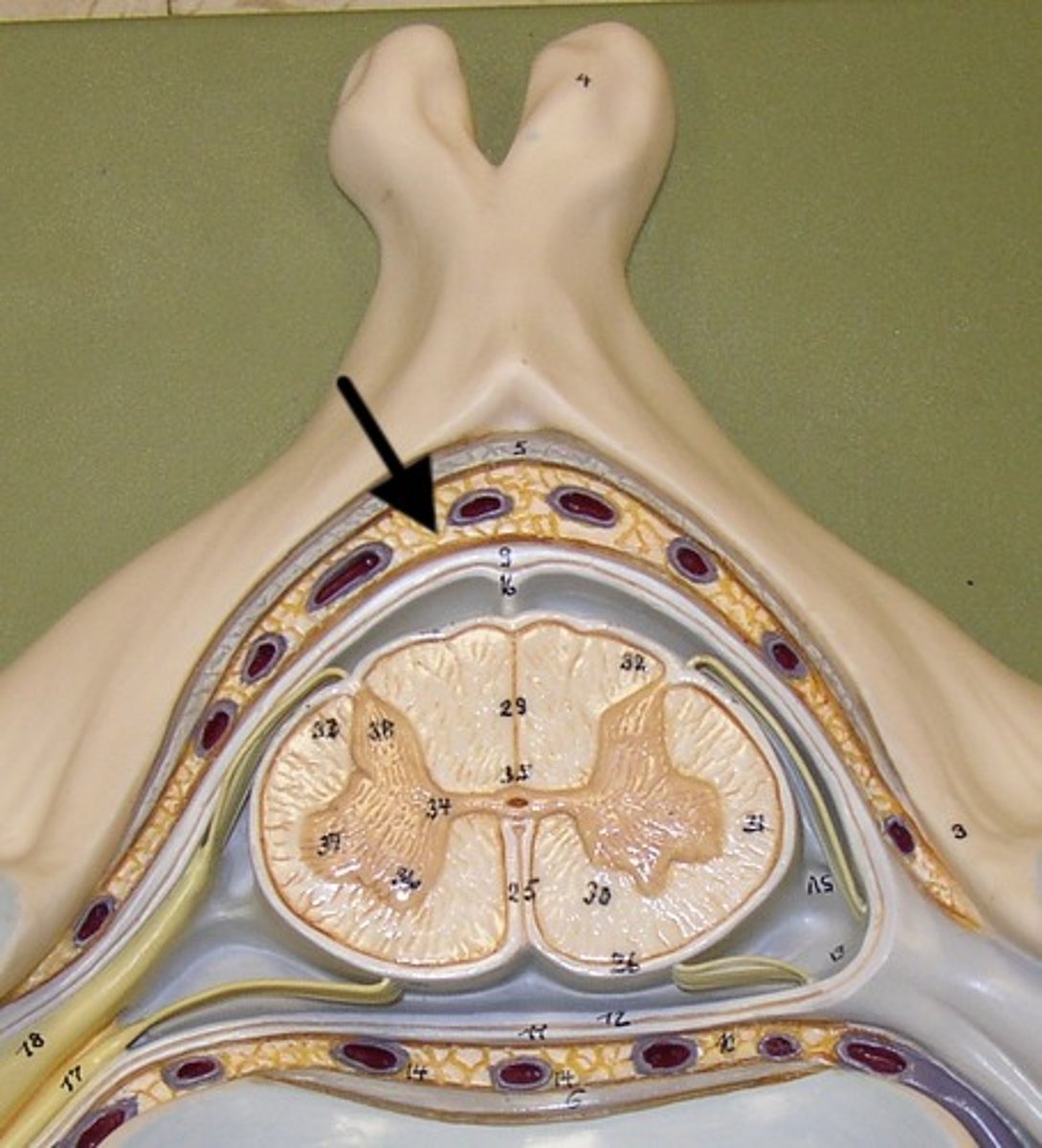 <p>space between the dura mater and the wall of the vertebral canal</p>
