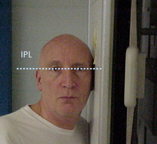 <ul><li><p>perp,&nbsp;</p></li><li><p>2” superior to EAM</p></li><li><p>entire cranium</p></li><li><p>suspend</p></li><li><p>122cm</p></li><li><p>erect: true lat, IOML // LA of IR, IPL perp to IR</p></li><li><p>recumbent: true lat with sponge</p></li><li><p>x-table: no OID, use sponge to raise posterior skull</p></li></ul><p></p>