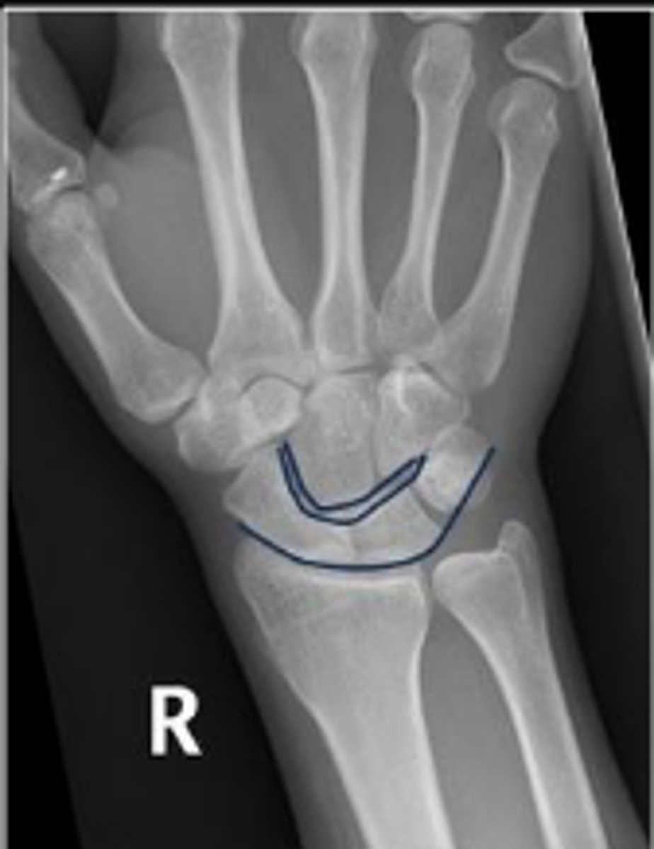 <p>What are the landmarks for the most distal line in the assessment?</p>