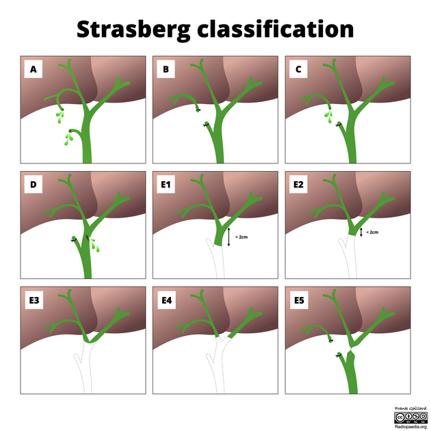 <p>A fístula (ducto menor - cístico e luschkas)</p><p>B estenose - ducto hepático direito aberrante<br>C fístula - ducto hepático direito aberrante<br>D fístula - ducto principal lateral à direita<br>E estenose - ducto principal </p>