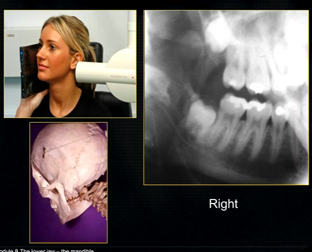 <p>oblique lateral technique allows you to take extraoral radiographs </p>