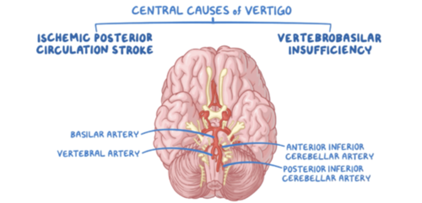 <p>The 4 Ds - DILPOLPIA, DYSPHAGIA, DYSARTHRIA or DYSMETRIA INDICATES CENTRAL VERTIGO</p><p>Loss of consciousness</p><p>Constant, unremitting</p><p>Vertical nystagmus</p><p>Cerebrovascular disease</p><p>Neurological symptoms eg hemiparesis, numbness, dysphagia, ataxia</p><p>Note that central causes of vertigo should be considered in any ELDERLY PATIENT WITH NEW ONSET OF ACUTE VERTIGO WITH NO OBVIOSU CAUSE</p><p>If there is vertigo with neurological signs, do MRI as this is sensitive for stroke</p>
