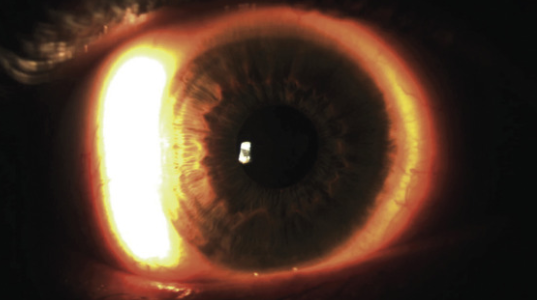 <p>what slit lamp technique is benig demonstarted in this&nbsp;</p>