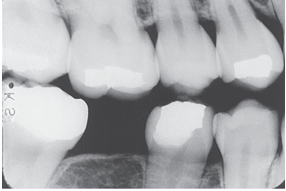 <p>What is the problem with this Overlapped contacts X-ray?</p>