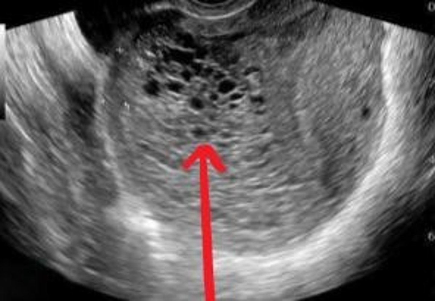 <p>Gestational Trophoblastic Disease</p>