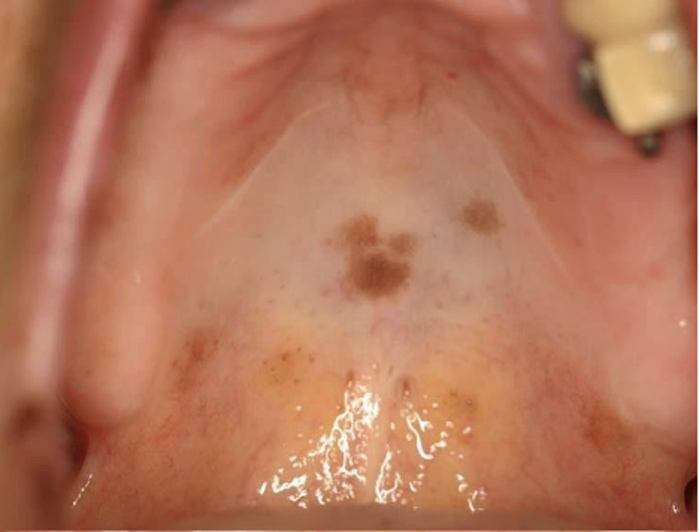 <p>What type of pigmented lesion?</p>